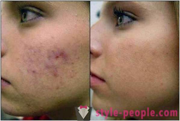 Peelingi kwas azelainowy: Liczba kosmetologów, zdjęcia przed i po