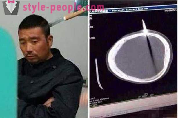 Chiński mężczyzna z nożem w głowie poszedł do lekarza