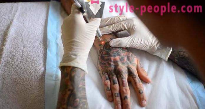 Laserowe usuwanie tatuażu. przeglądu