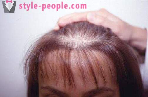 Darsonval włosy. darsonvalya zastosowanie w leczeniu i profilaktyce łysienia