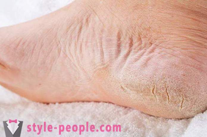 Sucha skóra na nogach: Przyczyny