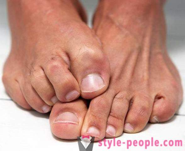 Sucha skóra na nogach: Przyczyny