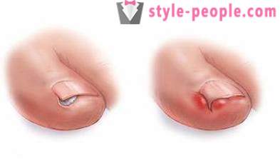 Wrastanie paznokci na duży palec u nogi: Przyczyny i leczenie
