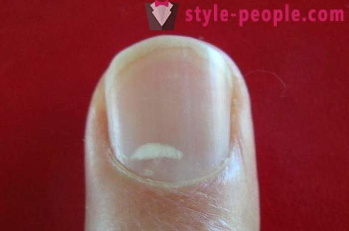 Co zrobić białe plamki na paznokciach