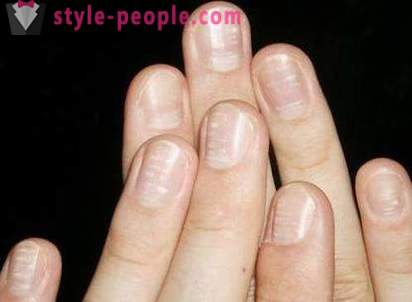 Co zrobić białe plamki na paznokciach